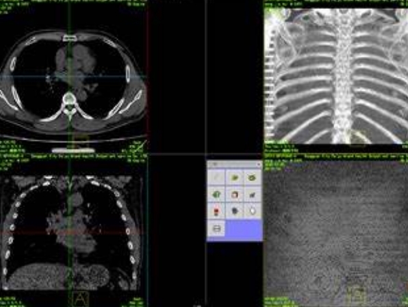 三維重建技術(shù)的革新：智能影像，精準(zhǔn)醫(yī)療的新篇章