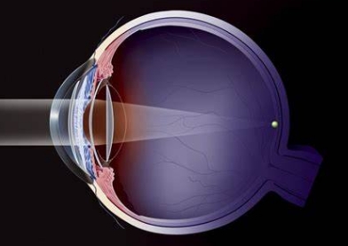 眼科醫(yī)療的新篇章：探索人工晶狀體的最新進展