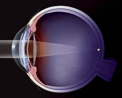 眼科醫(yī)療的未來：揭秘多焦點人工晶狀體的創(chuàng)新設計