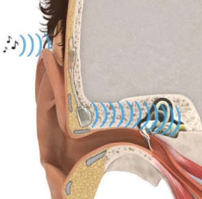 重塑聽(tīng)力，聆聽(tīng)夢(mèng)想：揭秘最新人工中耳植入技術(shù)的創(chuàng)新