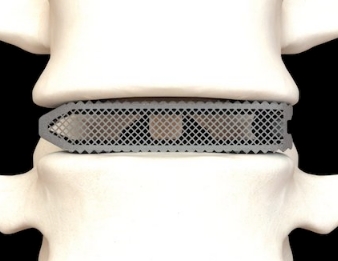 個性化脊柱治療的利器：3D打印脊柱植入物的技術(shù)進展