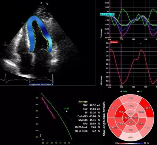 無創(chuàng)心臟成像的新選擇：實時三維超聲心動圖設備的功能與優(yōu)勢