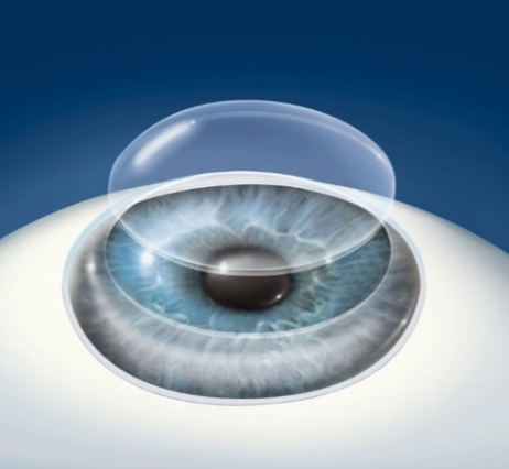 精準(zhǔn)眼科手術(shù)的未來(lái)：飛秒激光角膜移植系統(tǒng)的臨床應(yīng)用與價(jià)值