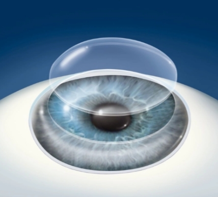 重塑視界：飛秒激光角膜手術(shù)讓清晰觸手可及