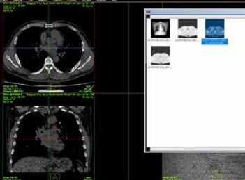 精準(zhǔn)手術(shù)導(dǎo)航的利器：術(shù)中三維影像重建系統(tǒng)提升外科手術(shù)精度