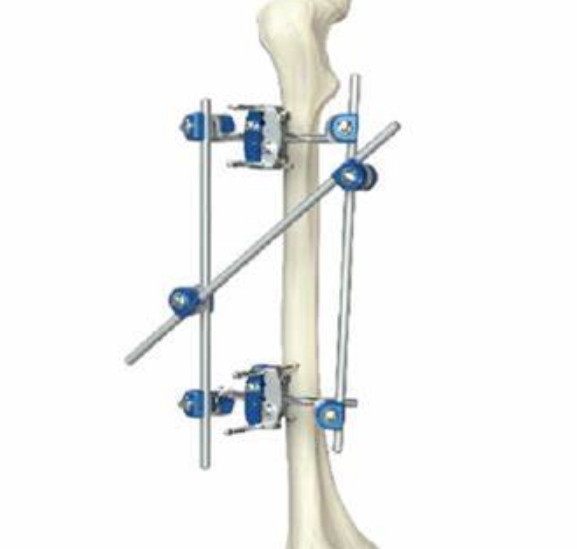 外固定支架：外部支撐，內(nèi)部修復(fù)——外固定支架在骨折治療中的作用