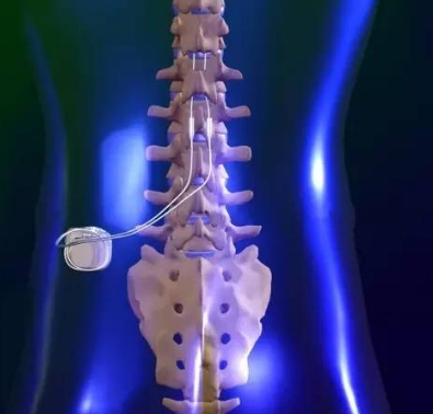 脊髓刺激器
