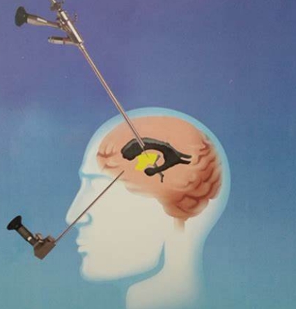 神經(jīng)內(nèi)鏡