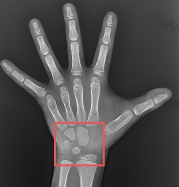 骨齡評估系統(tǒng)