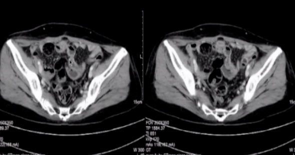 卵巢癌風(fēng)險(xiǎn)評(píng)估系統(tǒng)?