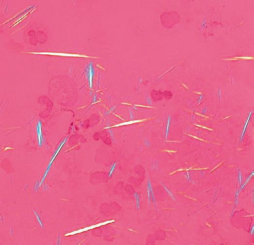 尿酸結(jié)晶，偏光